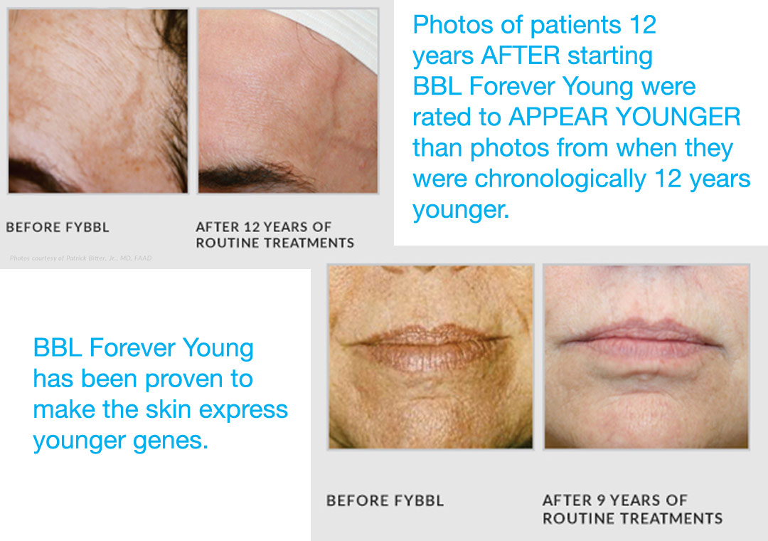 BBL Forever Young treatments stimulate younger gene expression, and with continued treatments, age appearance can be reduced by over a decade.  Bravia Deramtology offers Forever Young BBL