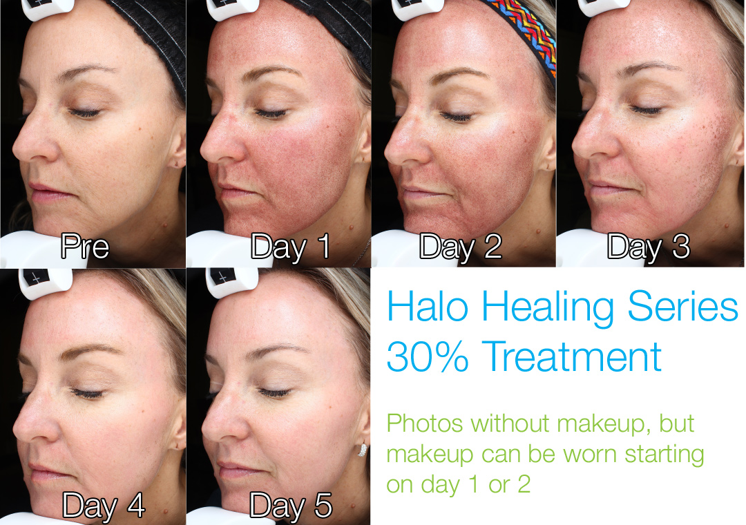 Halo at 30% - Notice the MENDS that come off to reveal the Halo Glow. Can wear makeup starting on Days 1-2. 