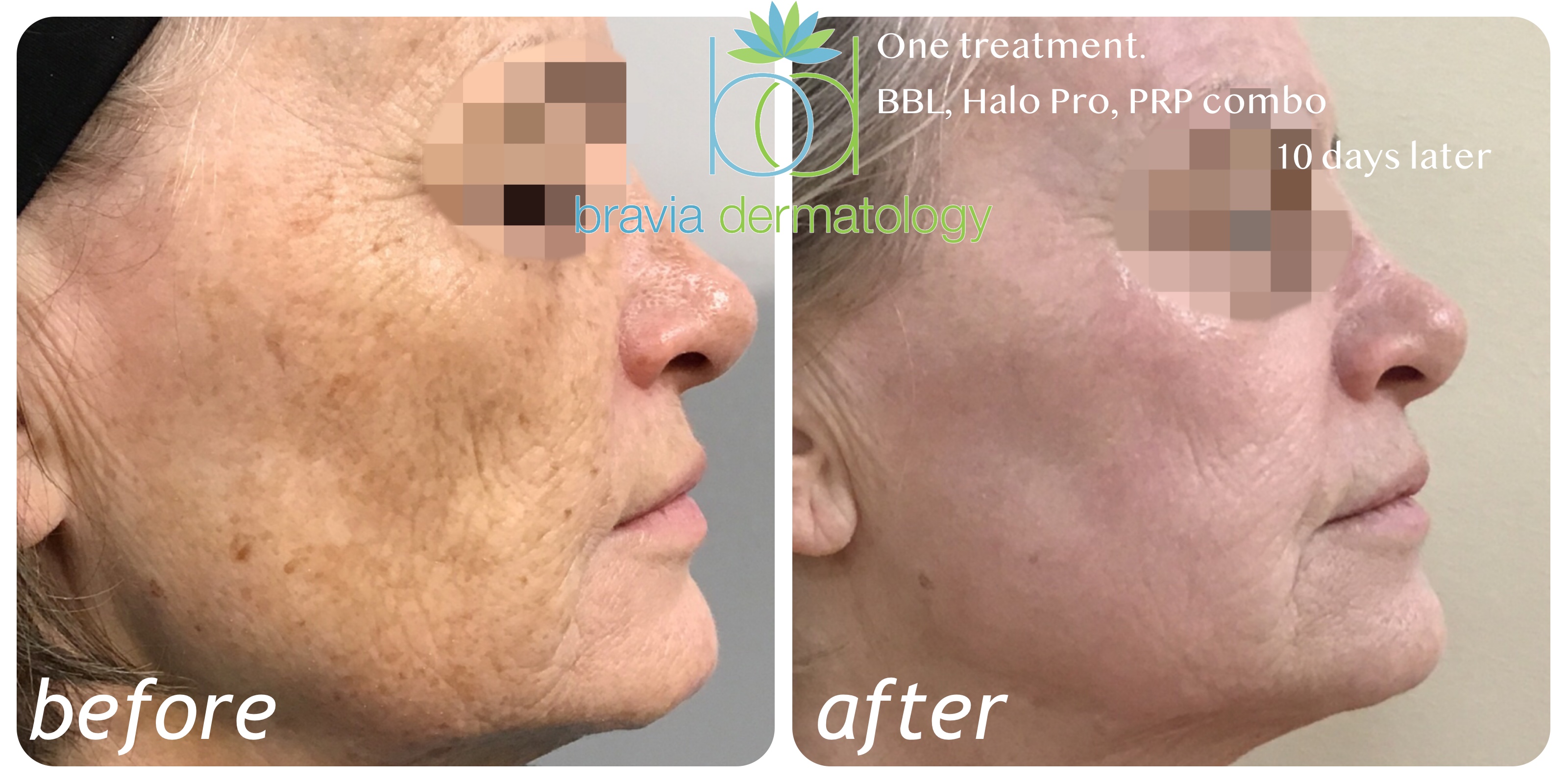 Combination treatment all done same day, BBL, Halo Pro, and Bravia Blood Boost. With combination treatments, the swelling can be more significant.