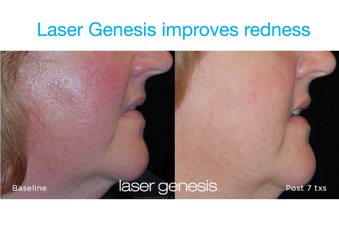 Laser Genesis treats facial redness.