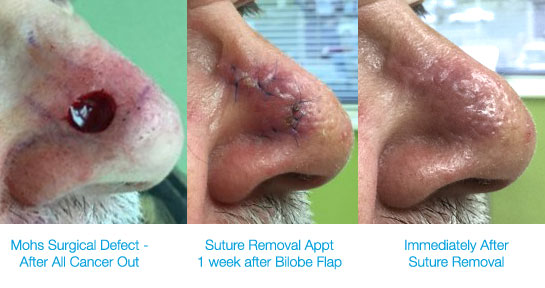 Surgical wound on nose before closure, and 1 week later before and after sutures removed.