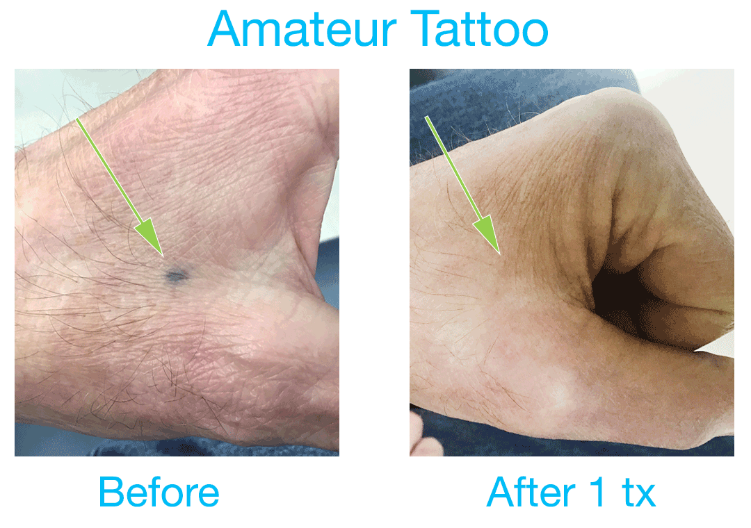 Tattoo Removal at Bravia Dermatology - before and after 1 treatment of an amateur tattoo.