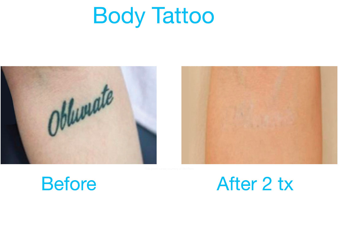 Body Tattoo before and after 2 treatments.