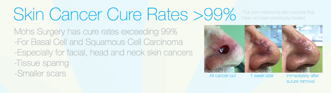 Mohs Surgery which Dr. Molenda performs has a 99% cure rate for non-melanoma skin cancers that have not been treated previously.